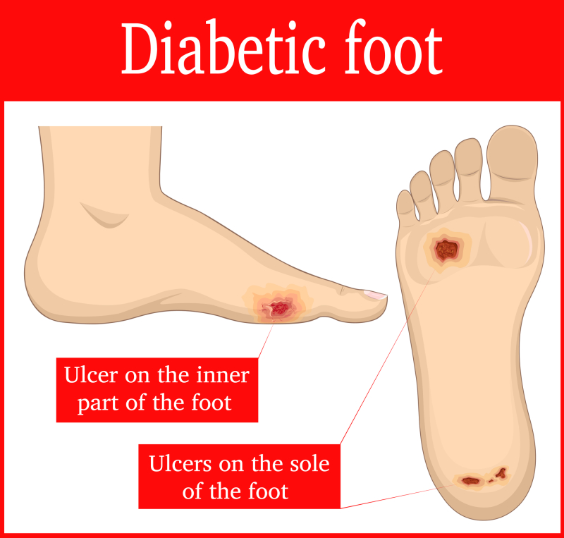 graphical representation of diabetic foot